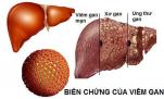 5 kiểu người dễ bị ung thư gan nhất, xem bạn có trong số đó không